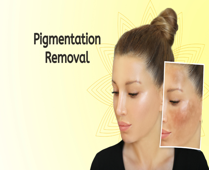Pigmentation Removal