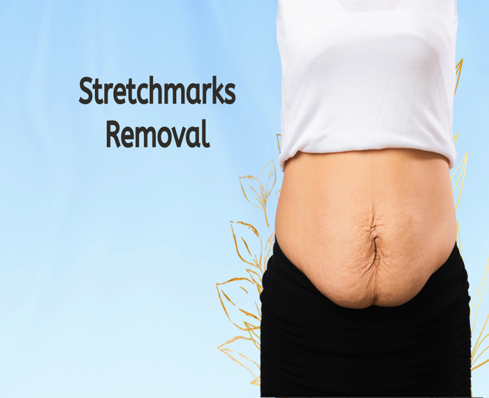 Stretchmarks Removal