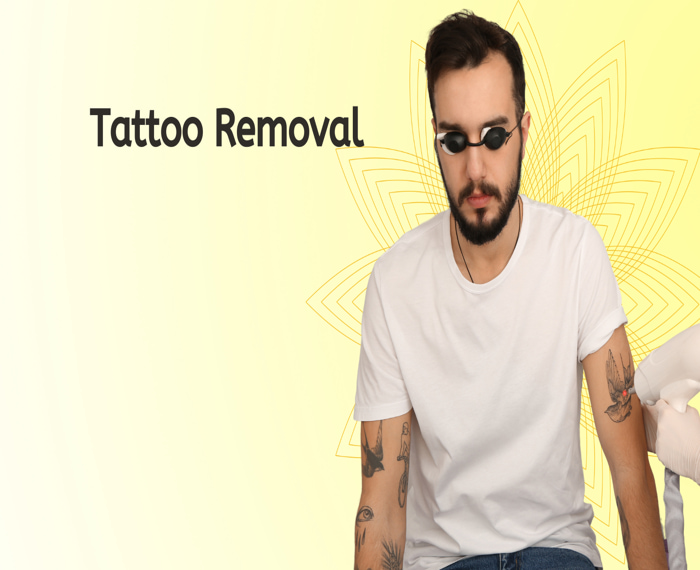 Tattoo Removal